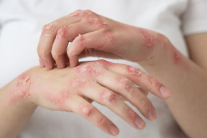 Maharashtra makes Leprosy a Notifiable Disease